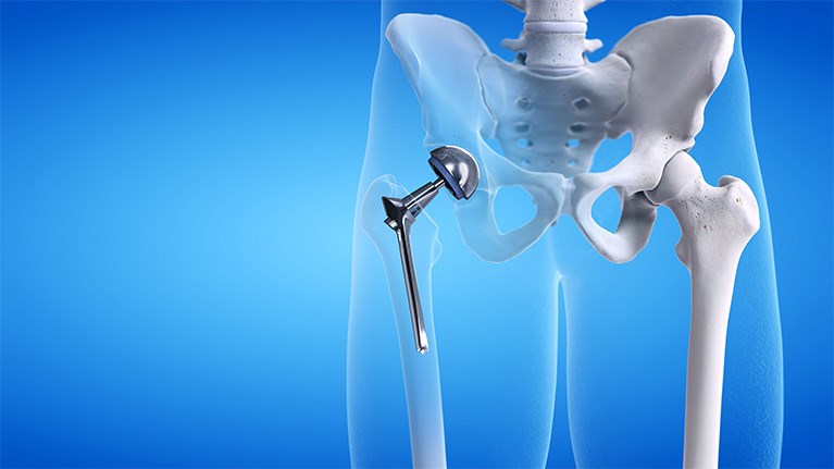 Hip Replacement Center